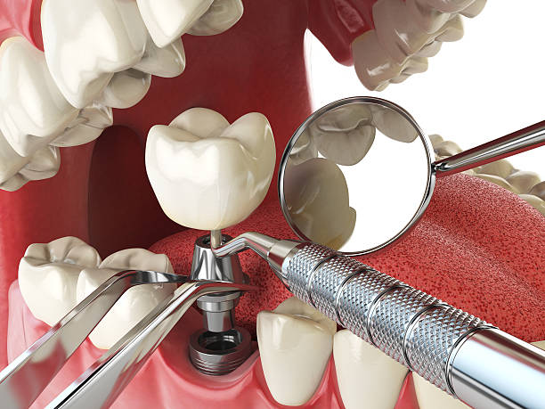 Best Emergency Treatment for Dental Infections or Abscesses in Atlantic Beach, FL